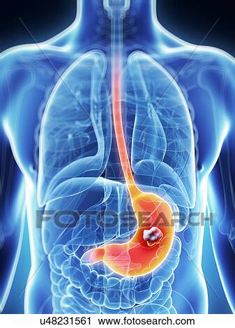 Human stomach cancer, illustration View Large Illustration Clip Art - Human stomach cancer, illustration. Fotosearch