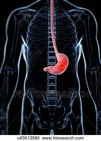 Human stomach cancer, illustration View Large Illustration Stock Illustration - Human stomach cancer, illustration. Fotosearch