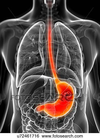 Stock Illustration - Human stomach cancer, illustration. Fotosearch