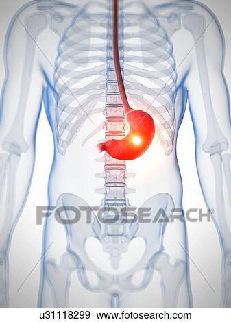 Stock Illustration - Human stomach ulcer, illustration. Fotosearch
