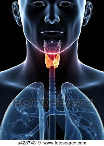 Stock Illustration - Human thyroid cancer, illustration. Fotosearch