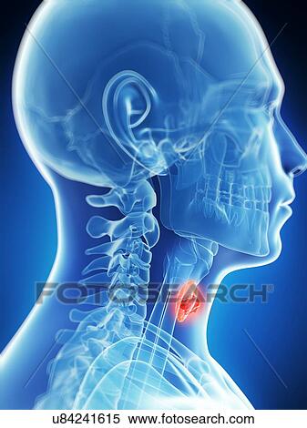 Stock Illustration - Human thyroid cancer, illustration. Fotosearch