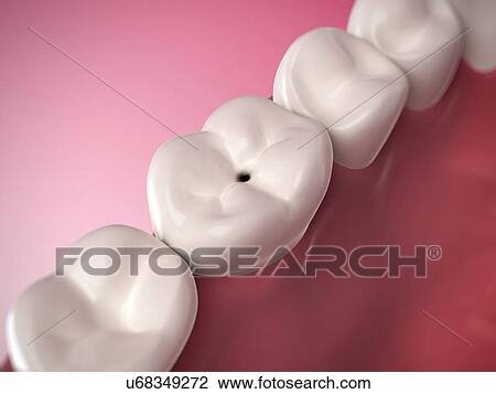 Drawing - Human tooth decay, illustration. Fotosearch