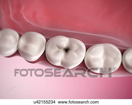 Stock Illustration - Human tooth decay, illustration. Fotosearch