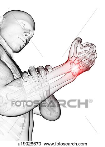Human wrist pain, illustration View Large Illustration Clipart - Human wrist pain, illustration. Fotosearch