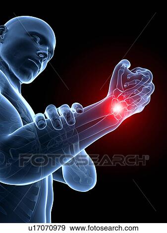 Human wrist pain, illustration View Large Illustration Stock Illustration - Human wrist pain, illustration. Fotosearch