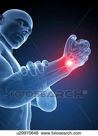 Human wrist pain, illustration View Large Illustration Stock Illustration - Human wrist pain, illustration. Fotosearch