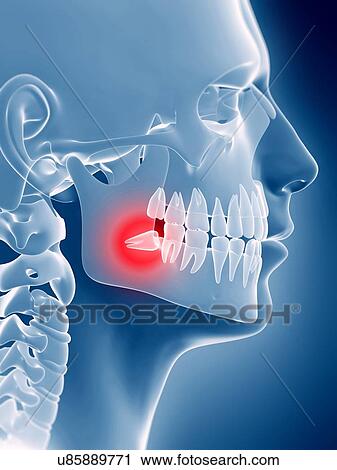 Impacted wisdom tooth, illustration View Large Illustration Clip Art - Impacted wisdom tooth, illustration. Fotosearch
