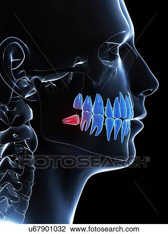 Impacted wisdom tooth, illustration View Large Illustration Drawing - Impacted wisdom tooth, illustration. Fotosearch