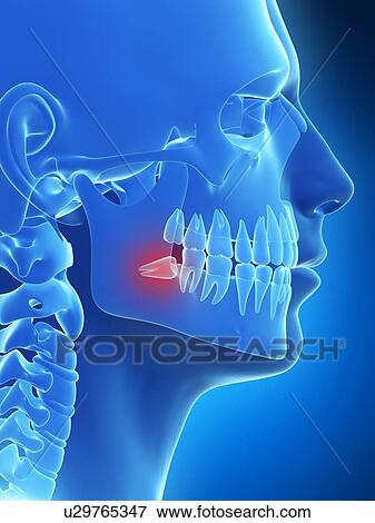 Stock Illustration - Impacted wisdom tooth, illustration. Fotosearch