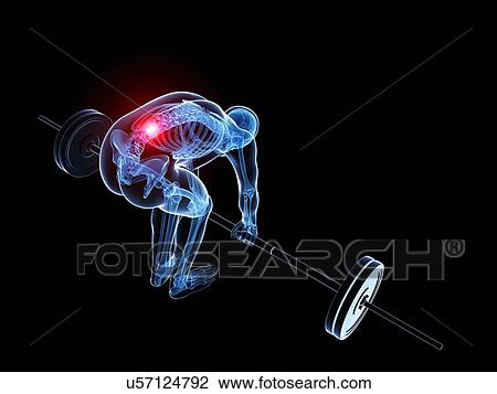 Weight lifting, incorrect posture View Large Illustration Drawing - Weight lifting, incorrect posture. Fotosearch