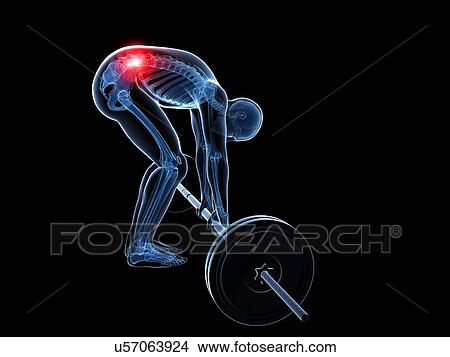 Weight lifting, incorrect posture View Large Illustration Stock Illustration - Weight lifting, incorrect posture. Fotosearch