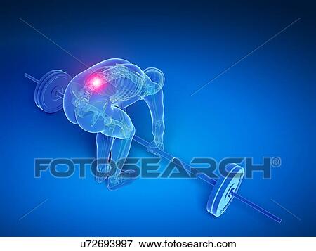 Weight lifting, incorrect posture View Large Illustration Stock Illustration - Weight lifting, incorrect posture. Fotosearch