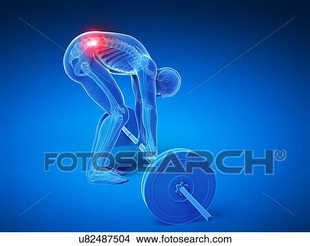 Stock Illustration - Weight lifting, incorrect posture. Fotosearch