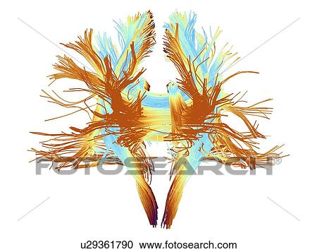 Stock Image - White matter fibres of the human brain. Fotosearch