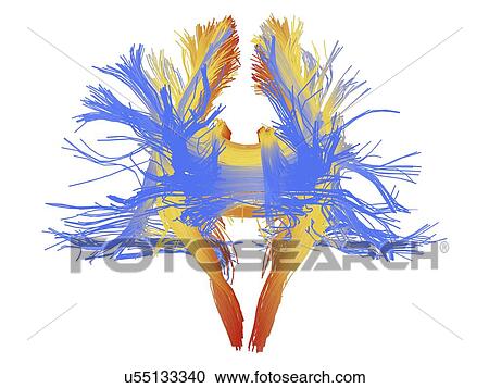 Stock Image - White matter fibres of the human brain. Fotosearch