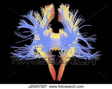 Stock Photo - White matter fibres of the human brain. Fotosearch