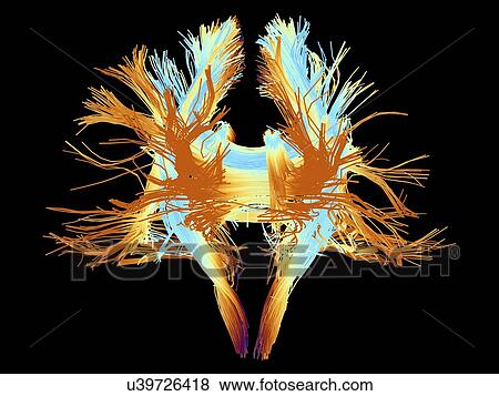 Stock Photo - White matter fibres of the human brain. Fotosearch