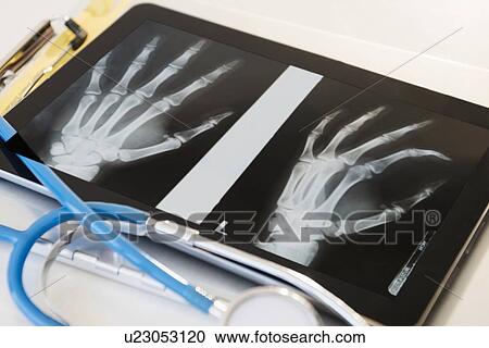 X-ray of human hand on digital tablet View Large Photo Image Stock Image - X-ray of human hand on digital tablet. Fotosearch