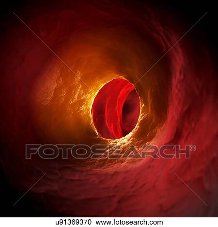Arteriosclerosis, illustration View Large Illustration Clipart - Arteriosclerosis, illustration. Fotosearch