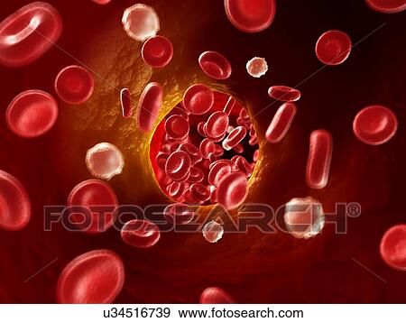 Arteriosclerosis, illustration View Large Illustration Stock Illustration - Arteriosclerosis, illustration. Fotosearch