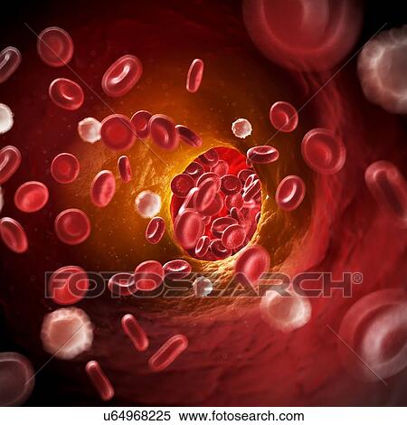 Arteriosclerosis, illustration View Large Illustration Stock Illustration - Arteriosclerosis, illustration. Fotosearch