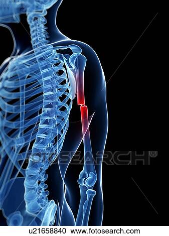 Broken arm bone, illustration View Large Illustration Clipart - Broken arm bone, illustration. Fotosearch