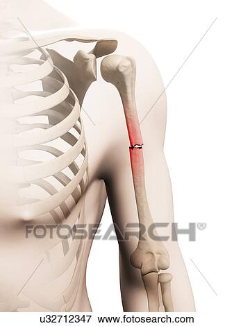 Broken arm bone, illustration View Large Illustration Stock Illustration - Broken arm bone, illustration. Fotosearch