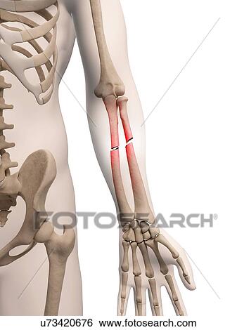 Broken arm bones, illustration View Large Illustration Stock Illustration - Broken arm bones, illustration. Fotosearch