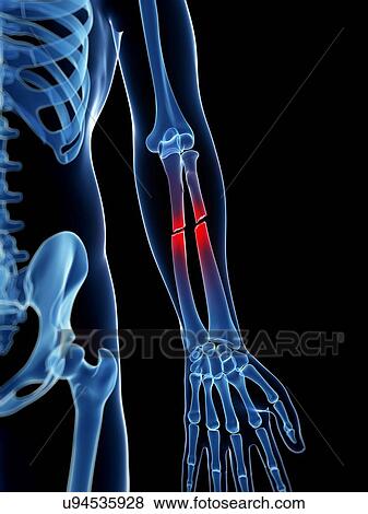 Broken arm bones, illustration View Large Illustration Stock Illustration - Broken arm bones, illustration. Fotosearch