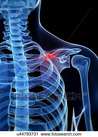Broken collar bone, illustration View Large Illustration Clip Art - Broken collar bone, illustration. Fotosearch