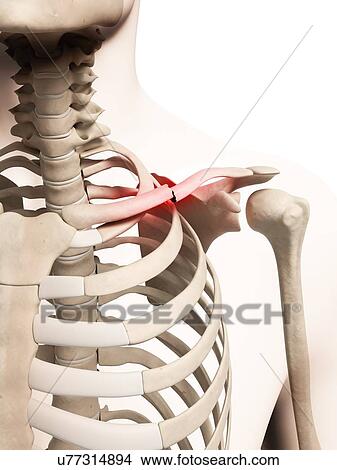 Broken collar bone, illustration View Large Illustration Stock Illustration - Broken collar bone, illustration. Fotosearch