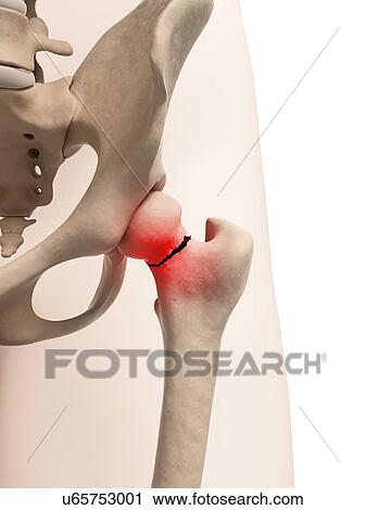 Clip Art - Broken hip bone, illustration. Fotosearch