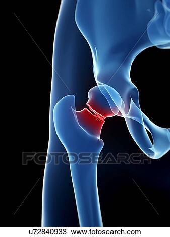 Drawing - Broken hip bone, illustration. Fotosearch