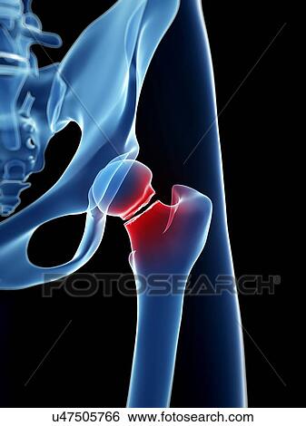 Broken hip bone, illustration View Large Illustration Stock Illustration - Broken hip bone, illustration. Fotosearch
