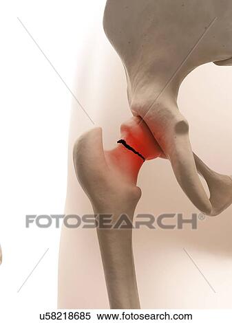 Stock Illustration - Broken hip bone, illustration. Fotosearch