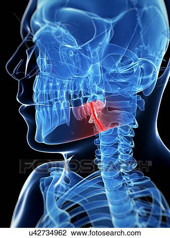 Drawing - Broken jaw bone, illustration. Fotosearch