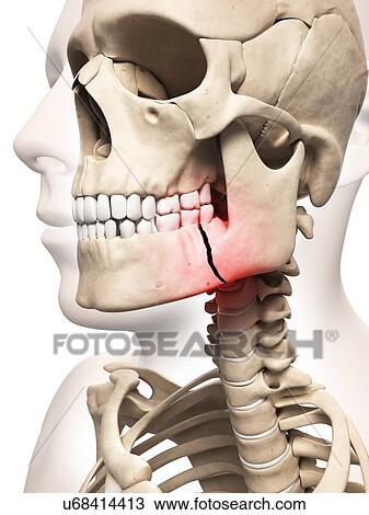 Broken jaw bone, illustration View Large Illustration Drawing - Broken jaw bone, illustration. Fotosearch