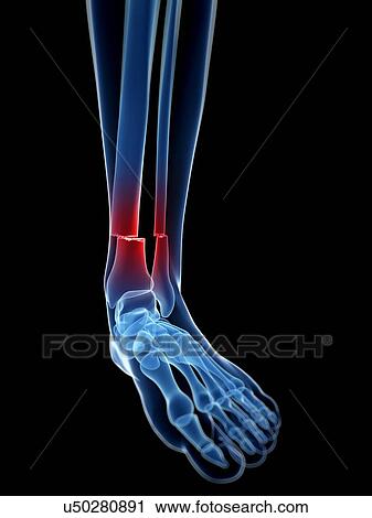 Clip Art - Broken leg bone, illustration. Fotosearch