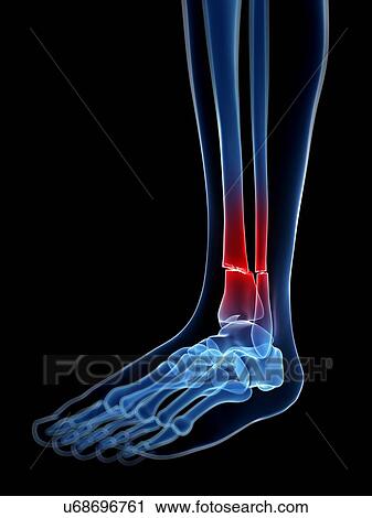 Clip Art - Broken leg bone, illustration. Fotosearch