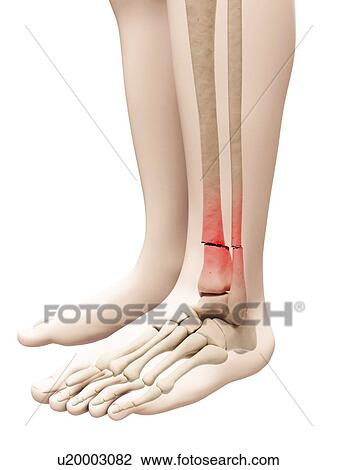 Drawing - Broken leg bone, illustration. Fotosearch