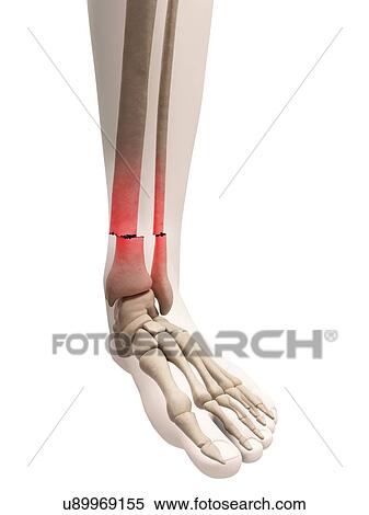 Stock Illustration - Broken leg bone, illustration. Fotosearch