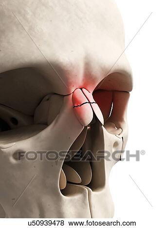 Broken nose, illustration View Large Illustration Stock Illustration - Broken nose, illustration. Fotosearch