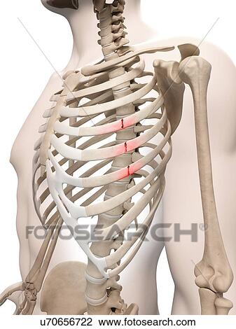Broken ribs, illustration View Large Illustration Drawing - Broken ribs, illustration. Fotosearch
