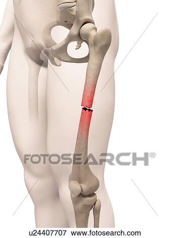 Stock Illustration - Broken thigh bone, illustration. Fotosearch