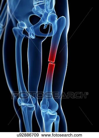 Stock Illustration - Broken thigh bone, illustration. Fotosearch