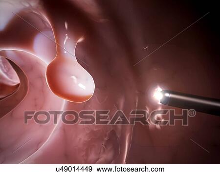Colonoscopy, illustration View Large Illustration Stock Illustration - Colonoscopy, illustration. Fotosearch