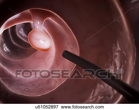 Stock Illustration - Colonoscopy, illustration. Fotosearch