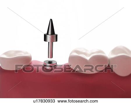 Drawing - Dental implant, illustration. Fotosearch