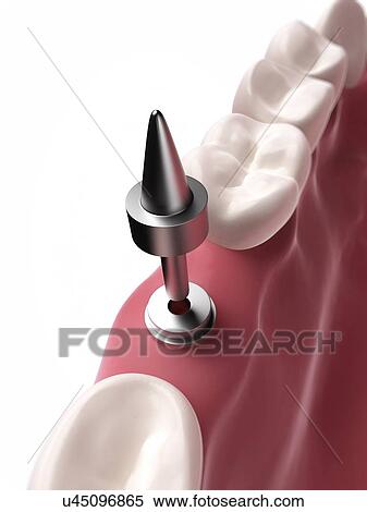 Stock Illustration - Dental implant, illustration. Fotosearch